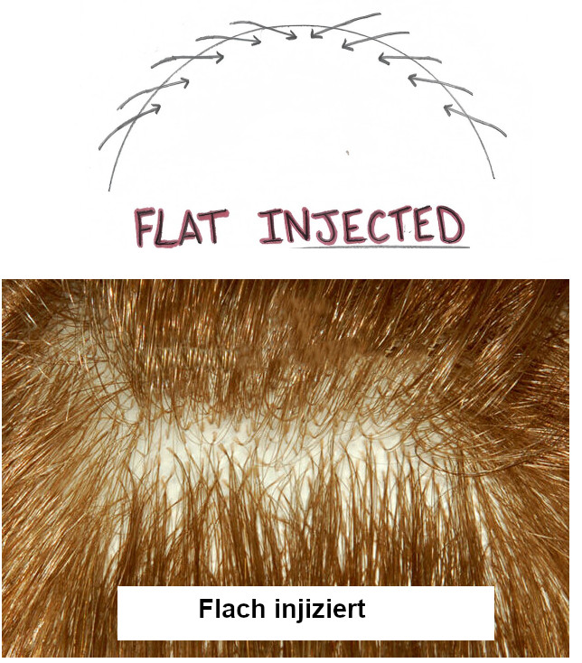 Flach Injizierte Haarsystem