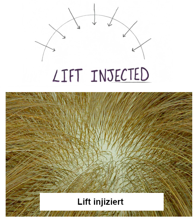 Lift Injizierte Haarsystem